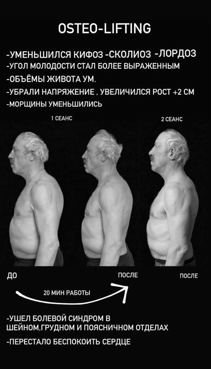 Фотографии лица до и после остео-лифтинга