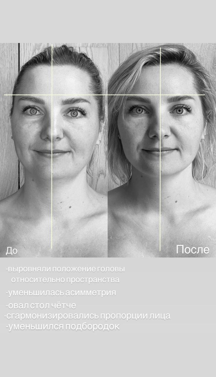 Фотографии лица до и после остео-лифтинга